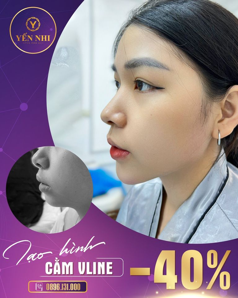 cằm vline