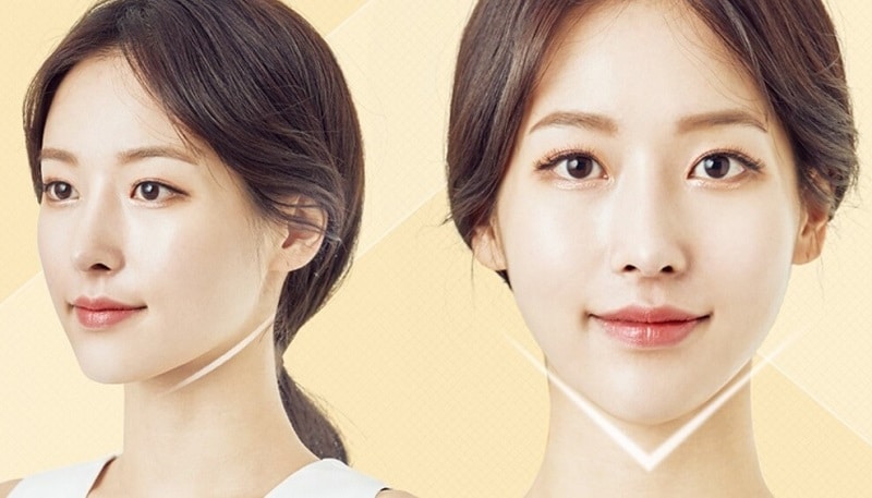 trẻ hóa đa điểm