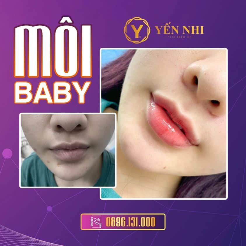 tạo hình môi baby trẻ hóa đa điểm