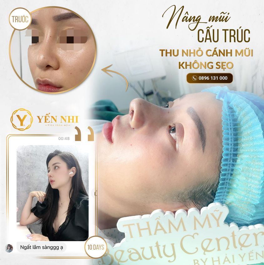 nâng mũi cấu trúc