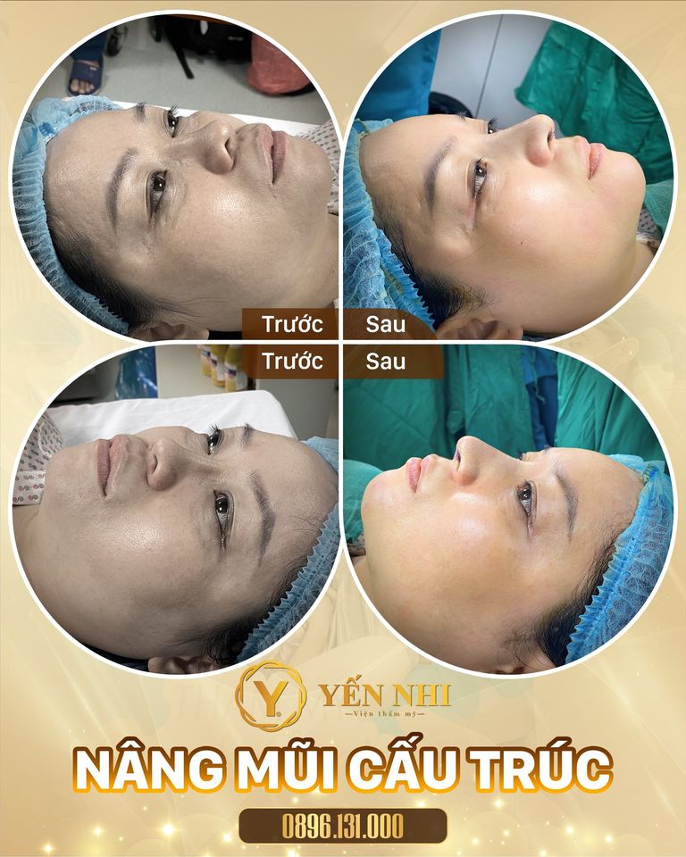 nâng mũi