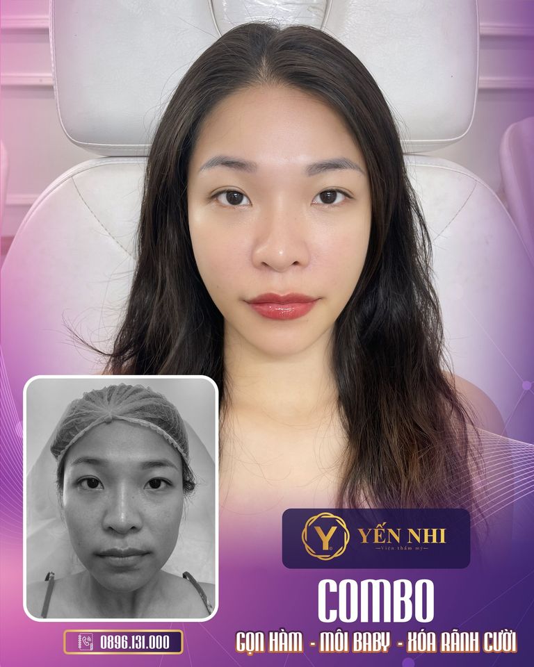 xóa rãnh cười
